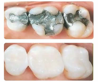 The Debate About Amalgam Fillings