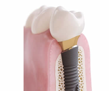 Choosing a Professional for Your Dental Implants in Central Falls