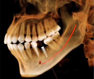 Private: Complete Your Smile with Dental Implants