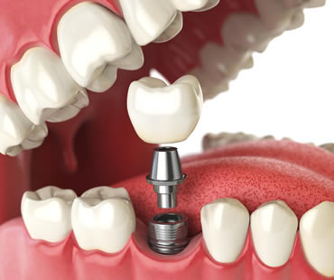 The Success Rate of Dental Implants