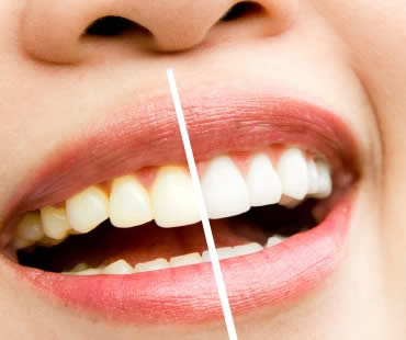 How to Deal with Tetracycline-Stained Teeth