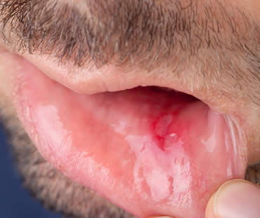 Examining Mouth Sores