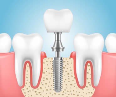 Dental Implants: The Most Advanced Choice for Tooth Restoration