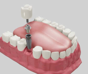 Private: The Many Benefits of Dental Implants