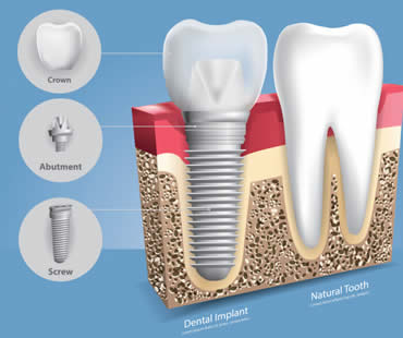 Private: A Thorough Look at Dental Implants